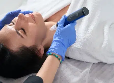 Microneedling San Antonio for Acne Scars - The Pearl Med Spa