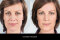 sculptra-before-after