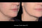 EMFACE | Jawline | After 4 treatments